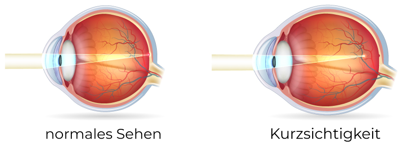 Kurzsichtigkeit